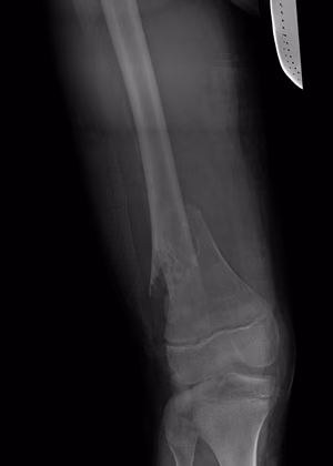 dis femur