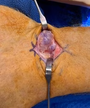 ganglion