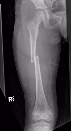 femur