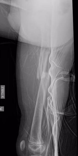 femur