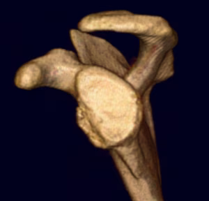 Bony bankart