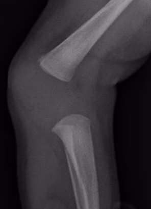cong knee dis