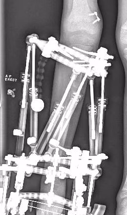 Fibular hemimelia