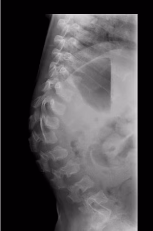 achondroplasia