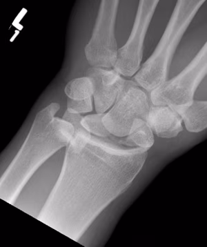 Lunate dislocation