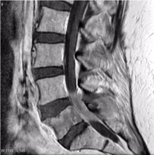 vert lymphoma 1
