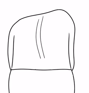 Rib hump