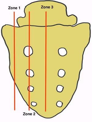 Sacral fractures
