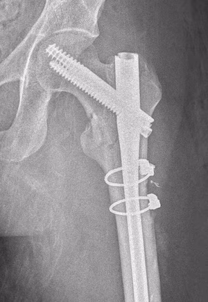Subtroch cerclage