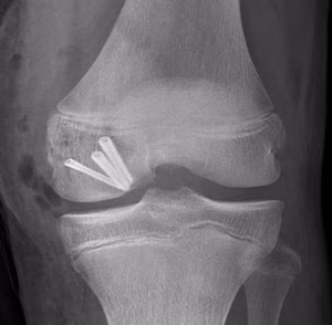 Medial Hoffa ORIF 1