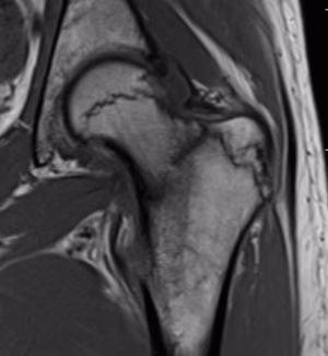 Hip Stress Fracture