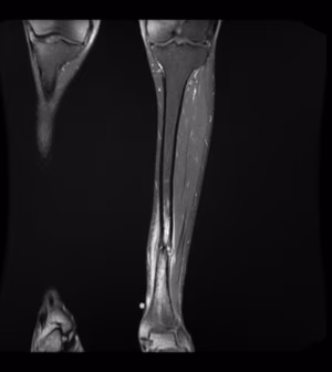 Tibial Stress Fracture