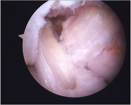 ACL PCL reconstruction