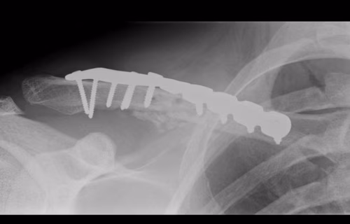 Clavicle Plate
