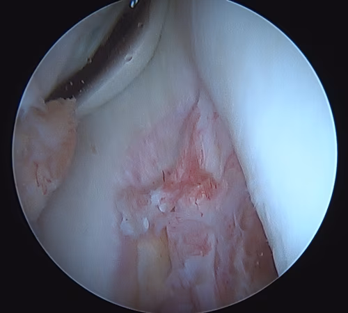 PCL femoral avulsion