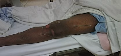 Knee dislocation external fixation