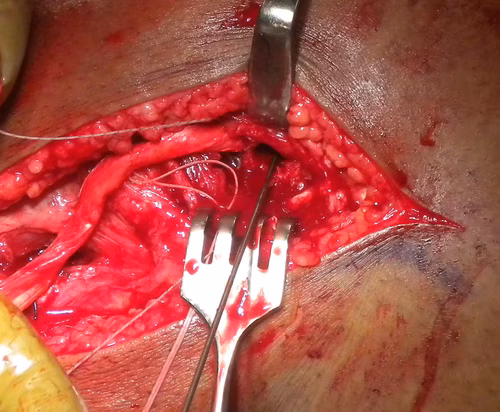 PLC Popliteus and LCL Femoral Drill Holes