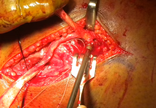 PLC Allograft Femoral Screw