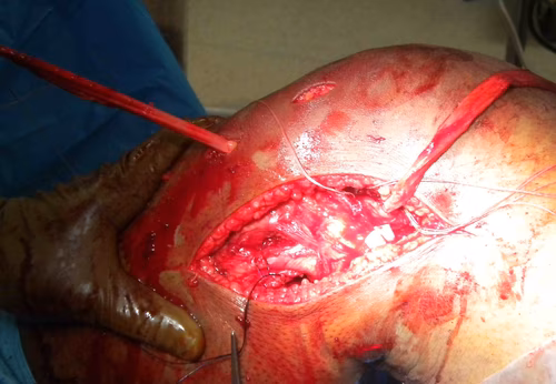 PLC Popliteus Allograft Anterior Through Tibia
