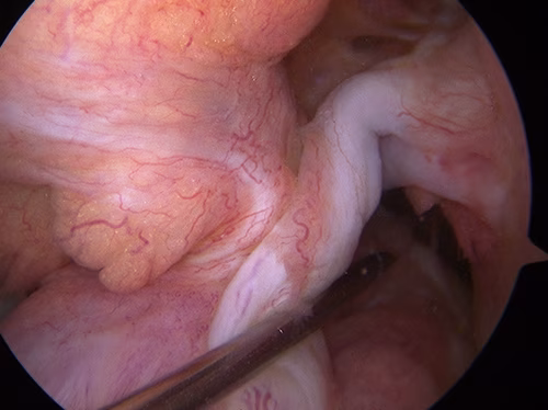 ACL Rupture Empty Lateral Wall