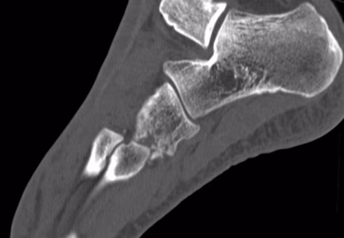 Cuboid Fracture Lis Franc