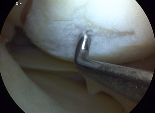 ICRS Grade 3 Chondral Lesion