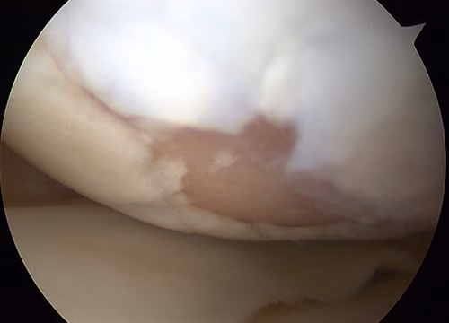 ICRS Grade 4 Chondral Lesion