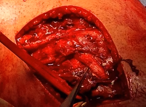 LCL graft passed through fibula