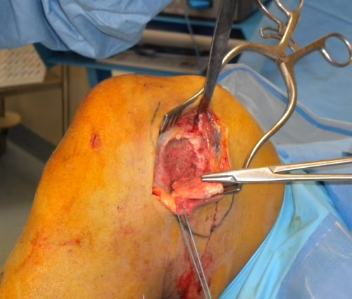 MCL Bony Avulsion Intraop 2