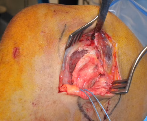 MCL Bony Avulsion Intraop