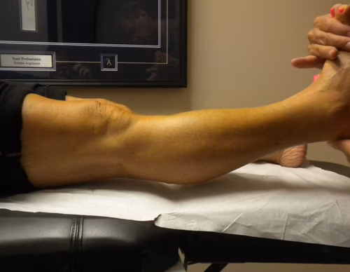 PCL Deficient Recurvatum