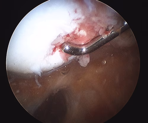 Patella Dislocation Removal Medial Facet Cartilage