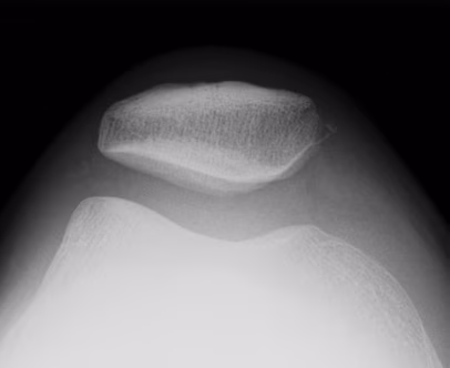 Patella Normal Trochlea
