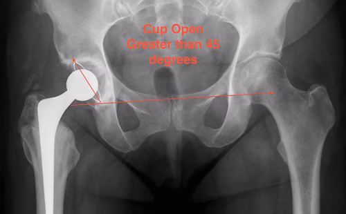 THR Acetabulum open > 45 degrees