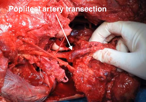 Popliteal artery transection 2