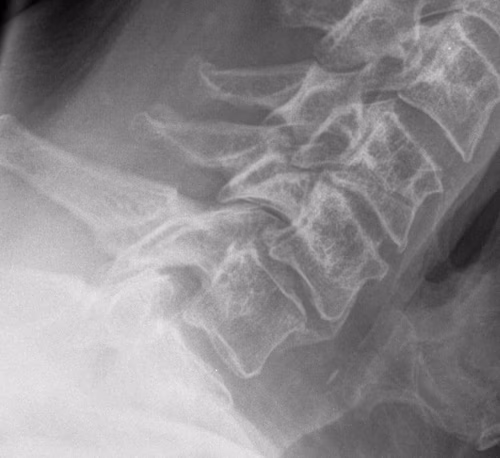 Cervical Spine OPLL