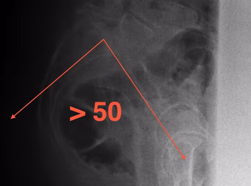 Pelvic Incidence > 50 degrees