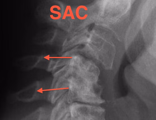 RA Subaxial Subluxaton SAC