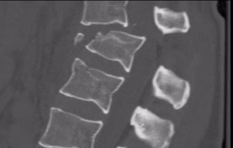 T12 L1 Soft Tissue Chance CT