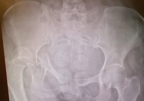 Hip fracture dislocation