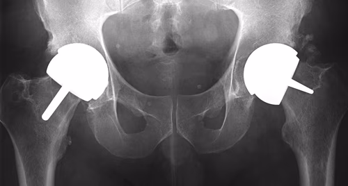 BHR Valgus v Varus Femoral Component