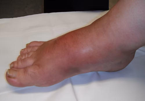 Charcot Foot