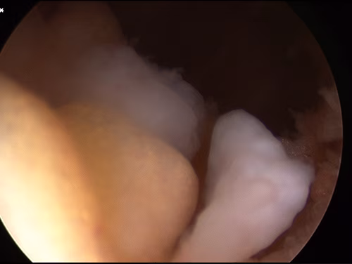 Knee Chondromatosis
