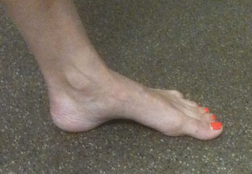 Foot Cavus
