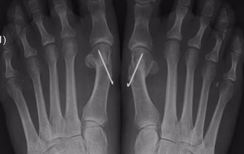 Hallux Valgus Chevron
