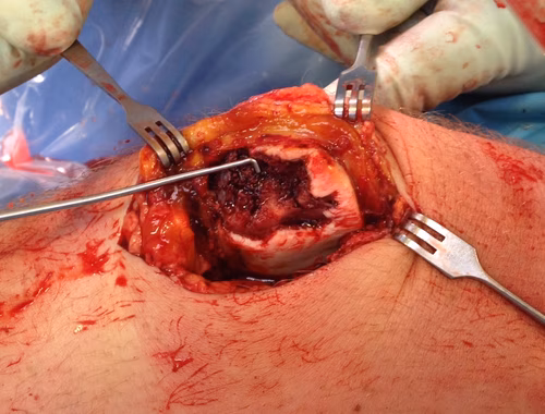 Patella Ostechondral Fracture