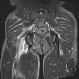 Proximal Hamstring Avulsion MRI Coronal
