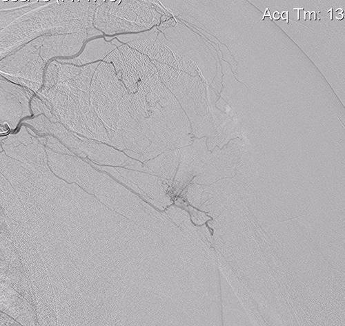 Shoulder RCC Embolisation