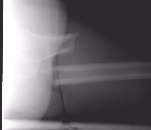 Subtrochanteric Lateral