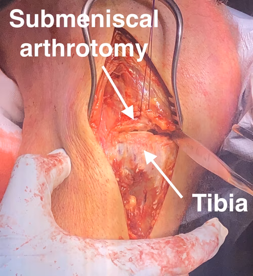 Tibia Anterolateral Approach 2